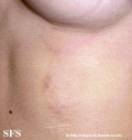 schistosomiasis-cutaneous