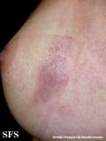 schistosomiasis-cutaneous