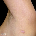 schistosomiasis-cutaneous
