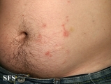 schistosomiasis-cutaneous