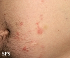 schistosomiasis-cutaneous