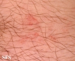 schistosomiasis-cutaneous