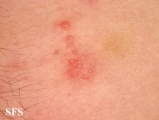schistosomiasis-cutaneous