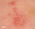 schistosomiasis-cutaneous