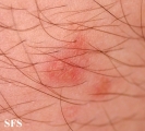schistosomiasis-cutaneous