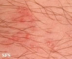 schistosomiasis-cutaneous
