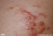 schistosomiasis-cutaneous