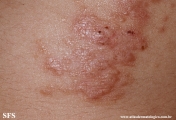 schistosomiasis-cutaneous