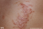 schistosomiasis-cutaneous