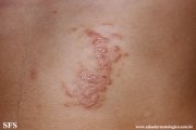 schistosomiasis-cutaneous