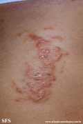 schistosomiasis-cutaneous