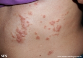 schistosomiasis-cutaneous