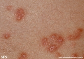 schistosomiasis-cutaneous