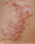 schistosomiasis-cutaneous