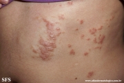 schistosomiasis-cutaneous