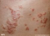 schistosomiasis-cutaneous