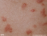 schistosomiasis-cutaneous
