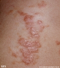 schistosomiasis-cutaneous