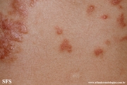 schistosomiasis-cutaneous