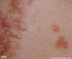 schistosomiasis-cutaneous