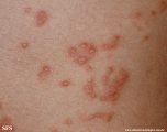 schistosomiasis-cutaneous