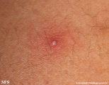 folliculitis
