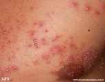 folliculitis