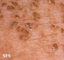 dermatosis nigricans for staphylococcus aureus