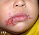 herpetic gingivostomatite