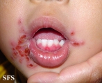 herpetic gingivostomatite