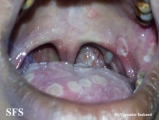 herpetic gingivostomatite