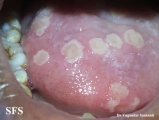 herpetic gingivostomatite
