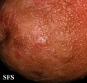 papulose bowenoide