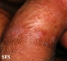 papulose bowenoide