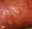 papulose bowenoide