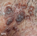 papulose bowenoide