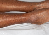 asteatotic dermatitis