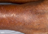 asteatotic dermatitis
