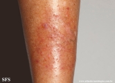 asteatotic dermatitis