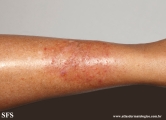 asteatotic dermatitis