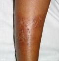 asteatotic dermatitis