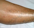 asteatotic dermatitis