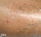 asteatotic dermatitis