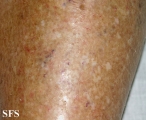 asteatotic dermatitis
