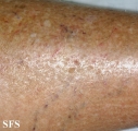 asteatotic dermatitis