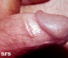 lymphangitis of the penis