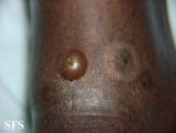 culicosis bullosa