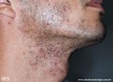 pseudofolliculitis barbae