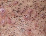 pseudofolliculitis barbae