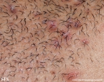 pseudofolliculitis barbae